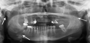Multiple_mandible_fractures