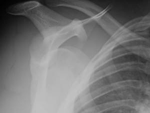 anterior shoulder dislocation