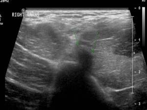 biceps tendon rupture ultrasound figure