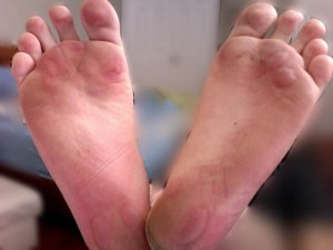 Friction_Blisters_On_Human_Foot